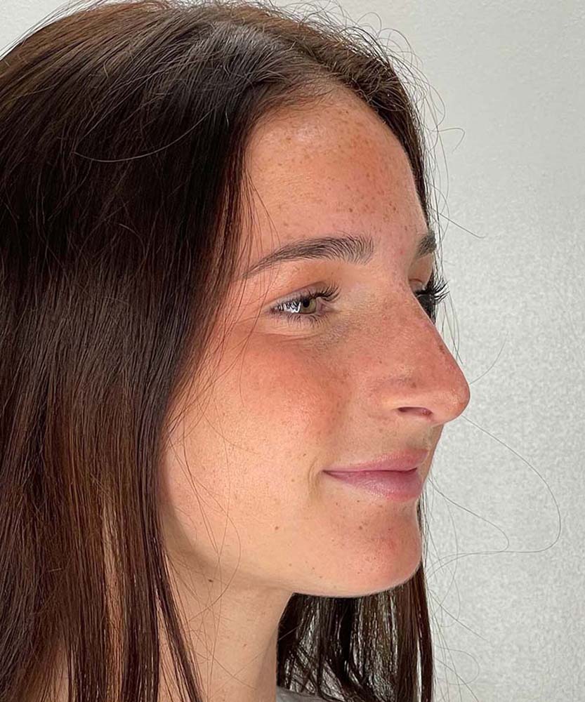 Rhinoplasty Before & After Image