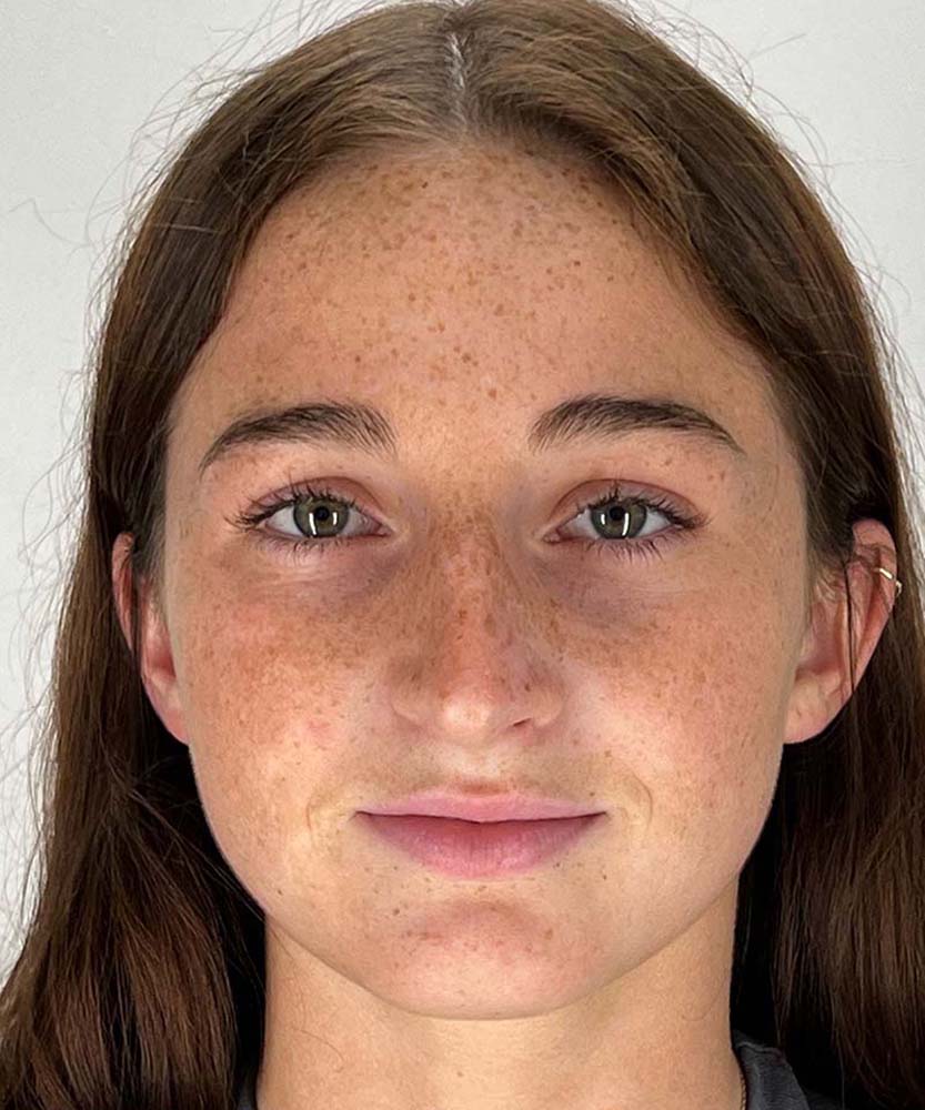 Rhinoplasty Before & After Image