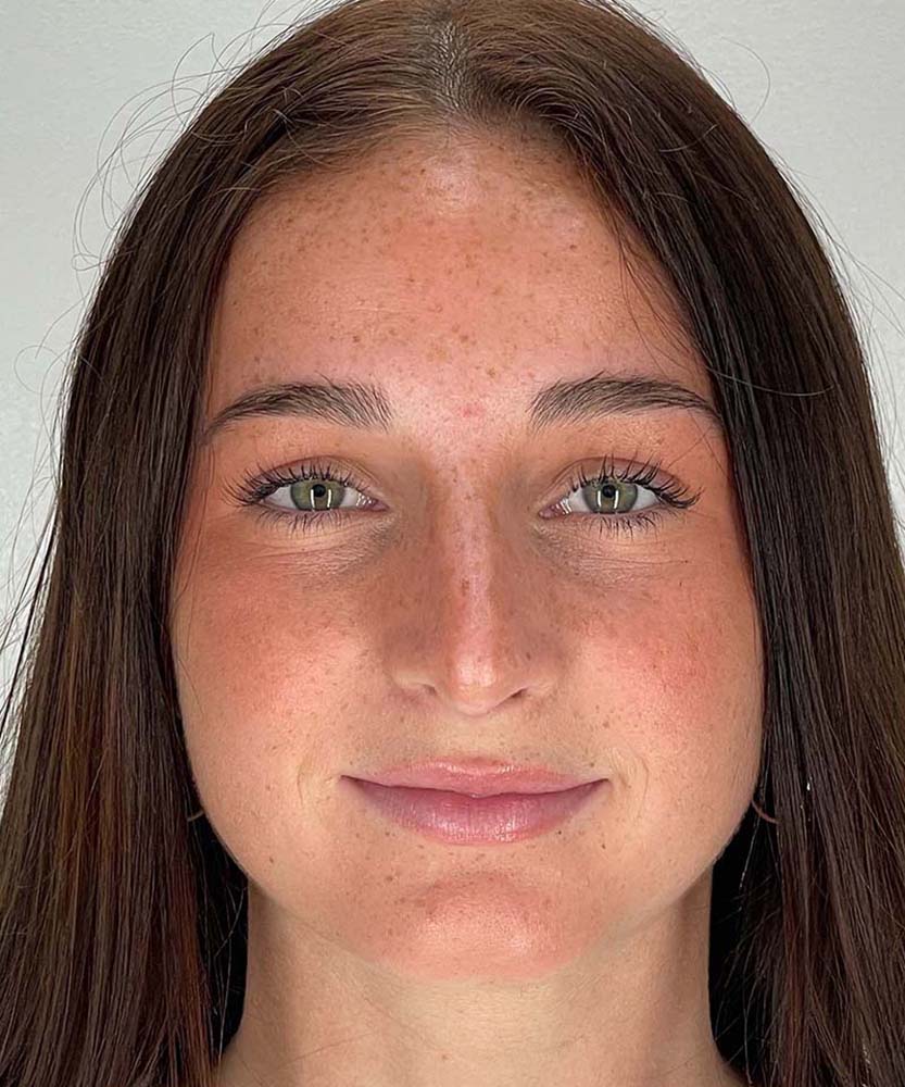 Rhinoplasty Before & After Image