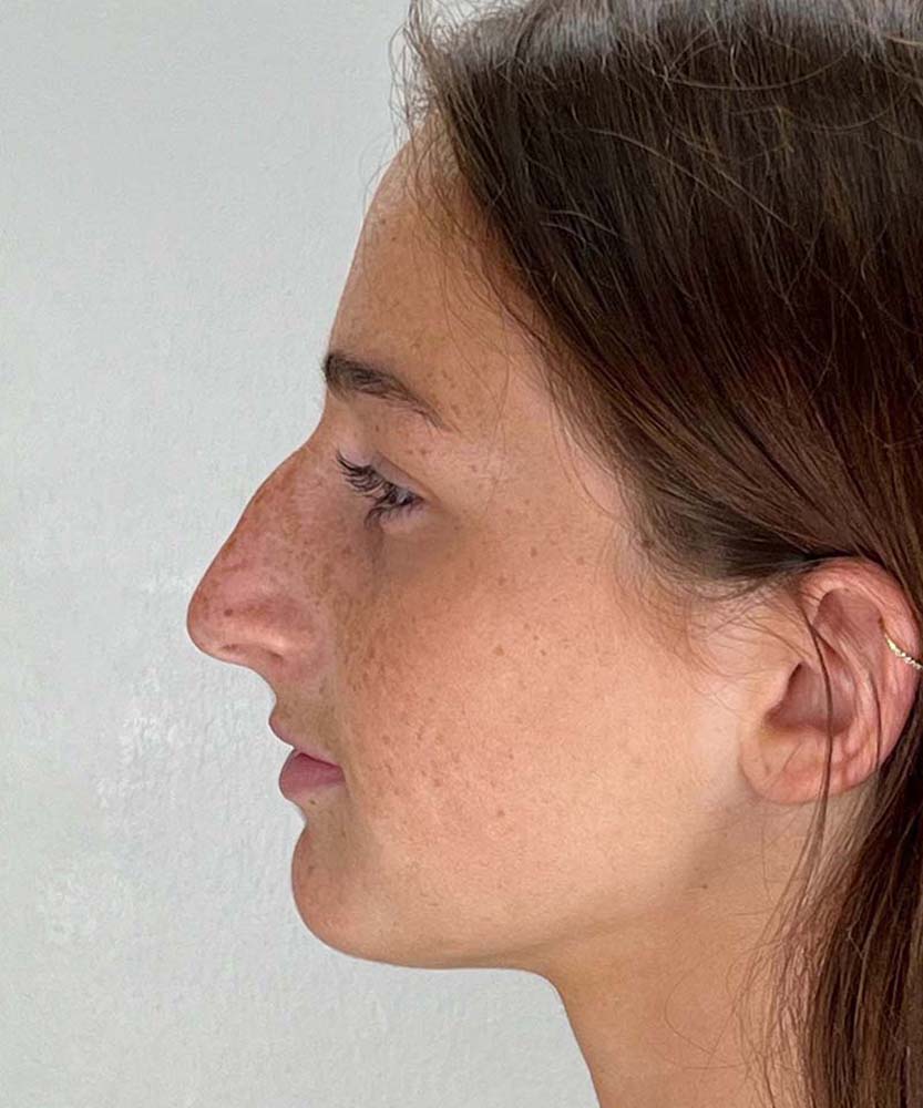 Rhinoplasty Before & After Image