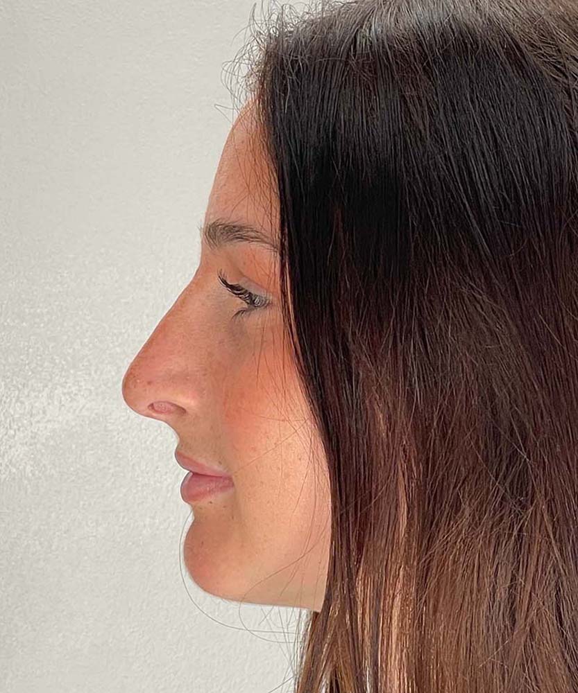 Rhinoplasty Before & After Image