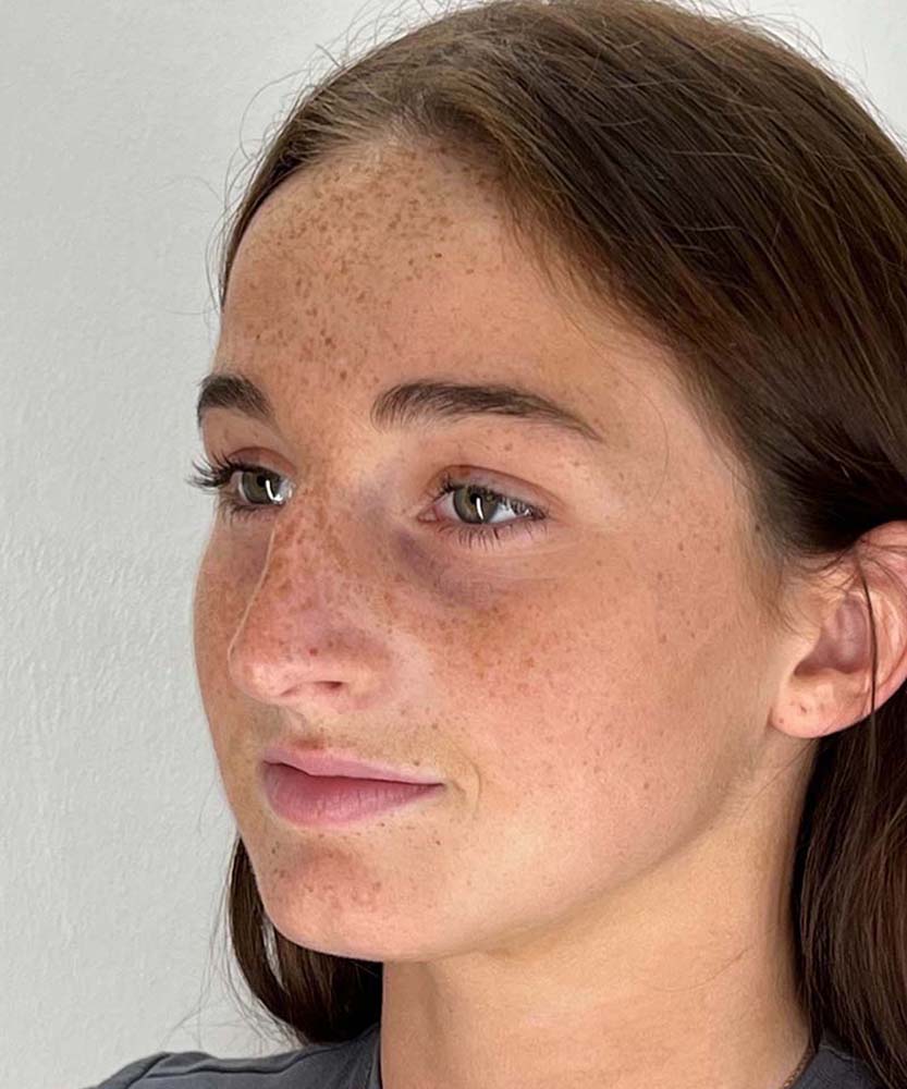 Rhinoplasty Before & After Image