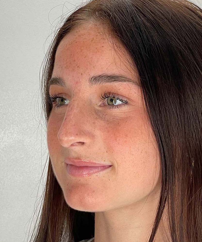 Rhinoplasty Before & After Image