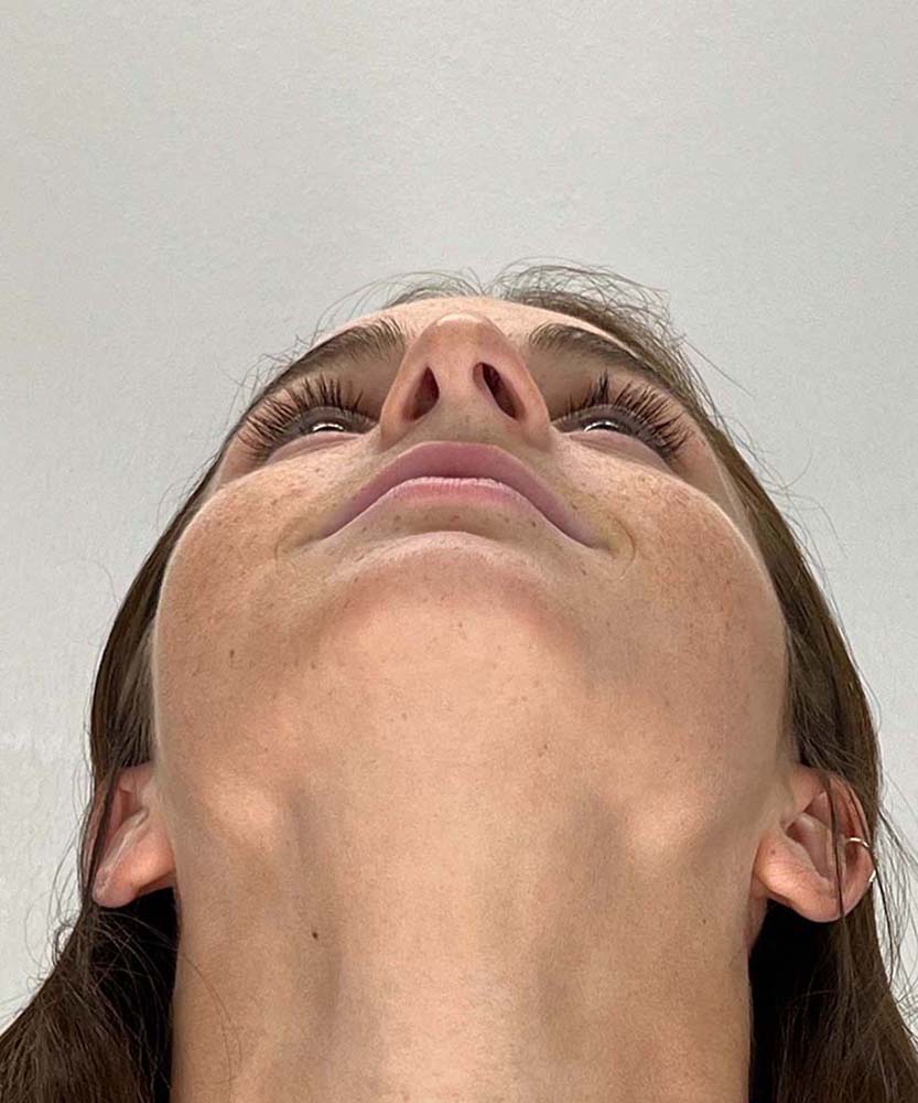 Rhinoplasty Before & After Image