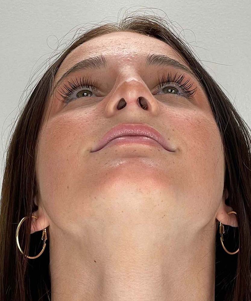 Rhinoplasty Before & After Image