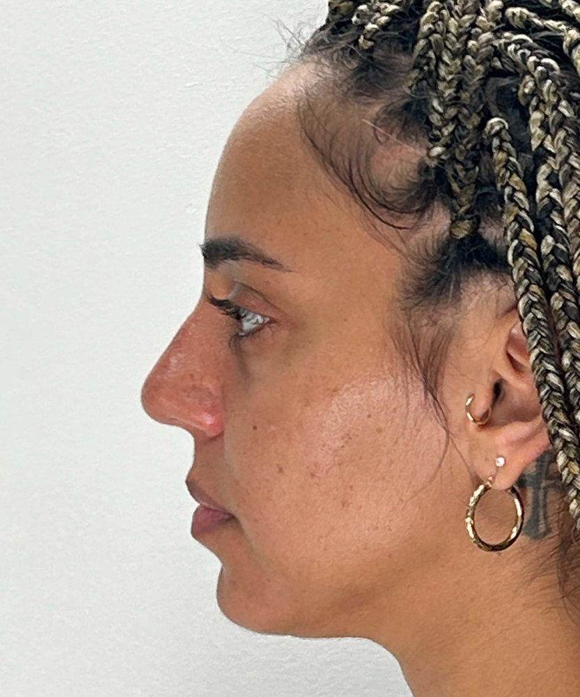 Sculptra Before & After Image