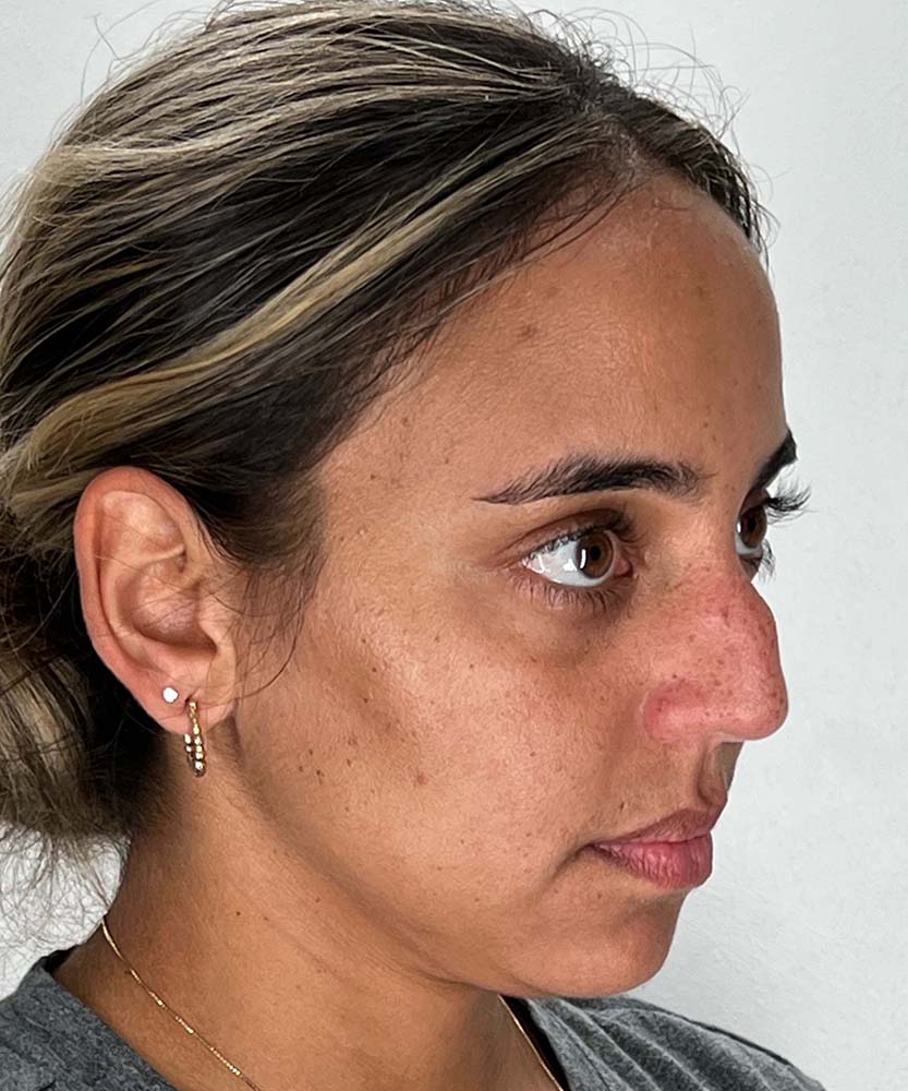 Rhinoplasty Before & After Image