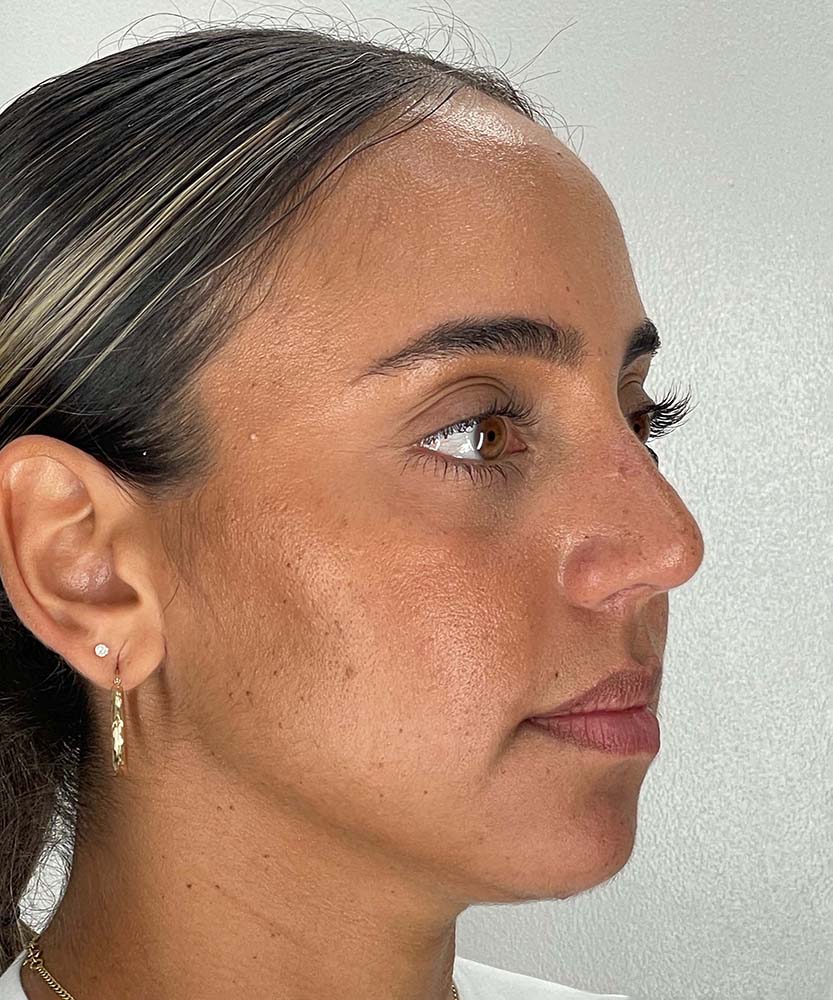 Rhinoplasty Before & After Image