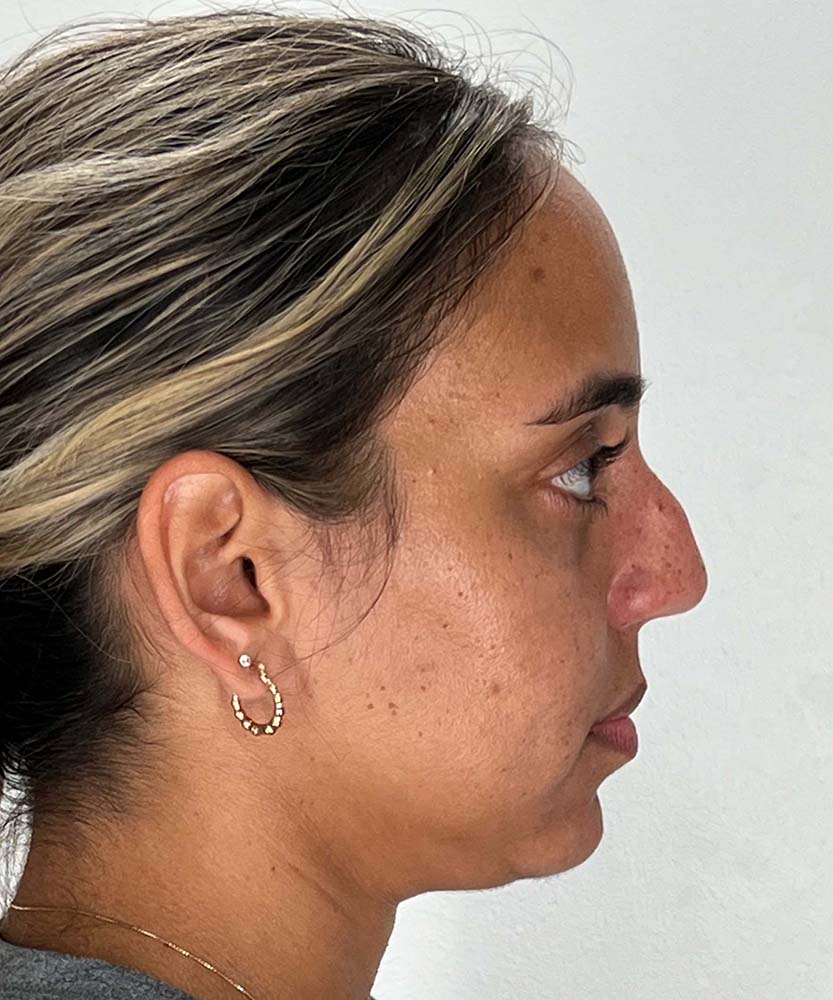 Rhinoplasty Before & After Image