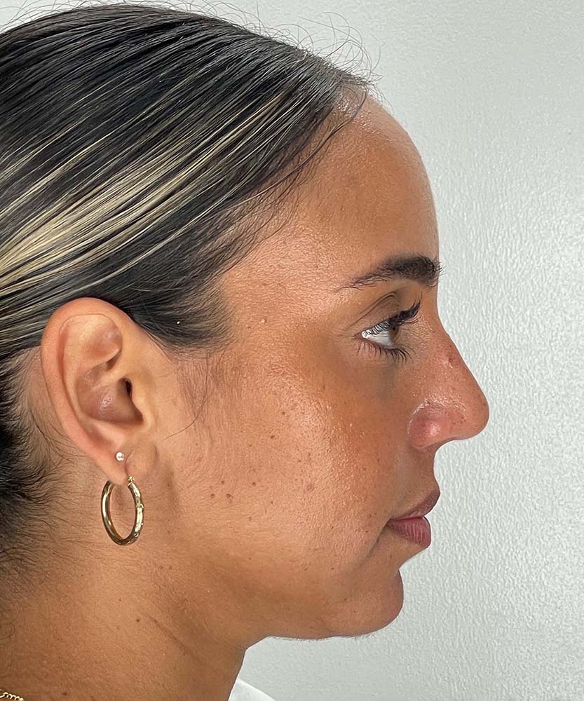 Rhinoplasty Before & After Image