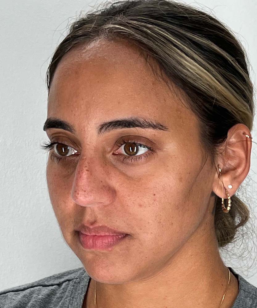 Rhinoplasty Before & After Image