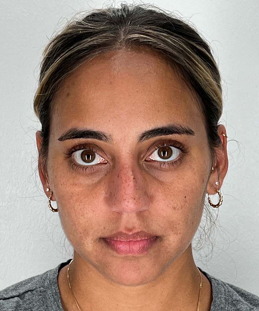 Rhinoplasty Before & After Image