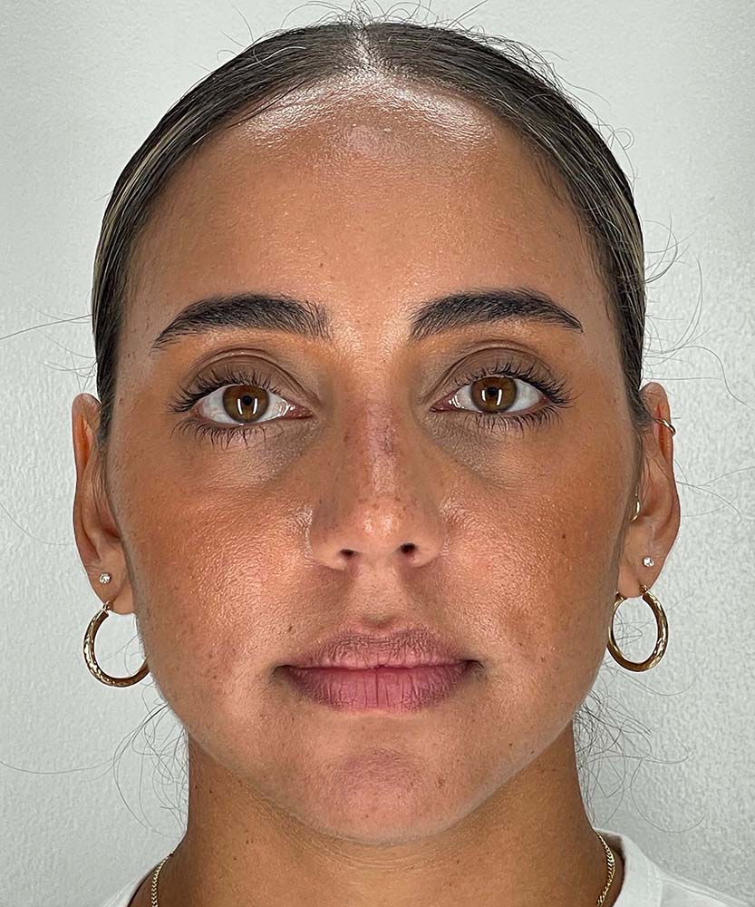 Rhinoplasty Before & After Image