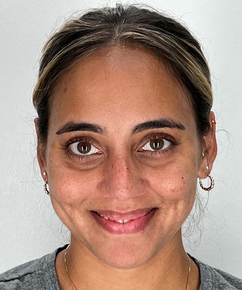 Rhinoplasty Before & After Image