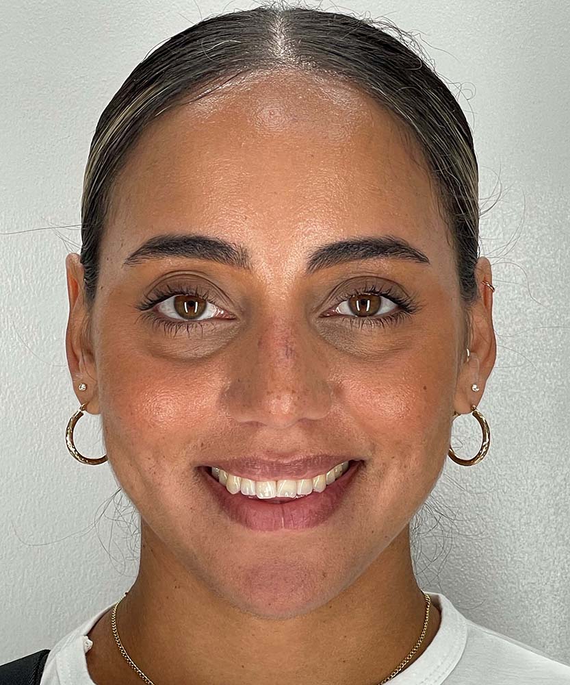 Rhinoplasty Before & After Image