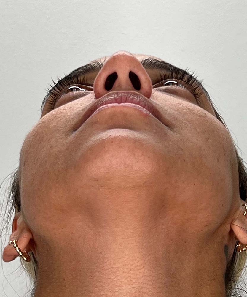 Rhinoplasty Before & After Image