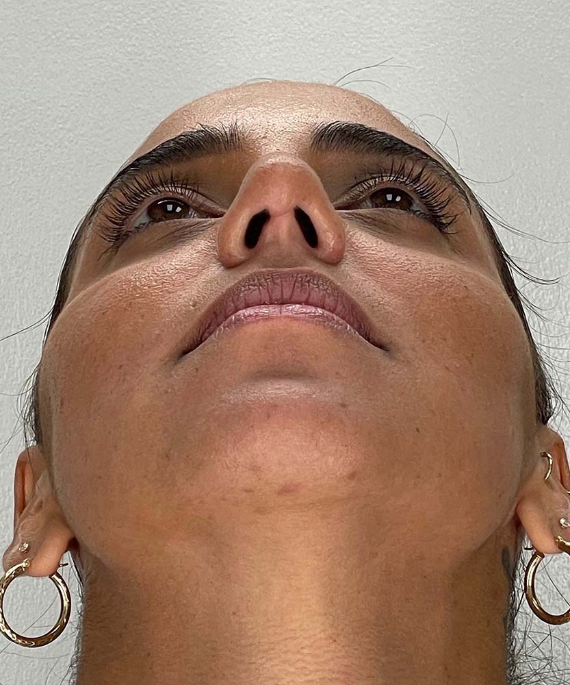 Rhinoplasty Before & After Image