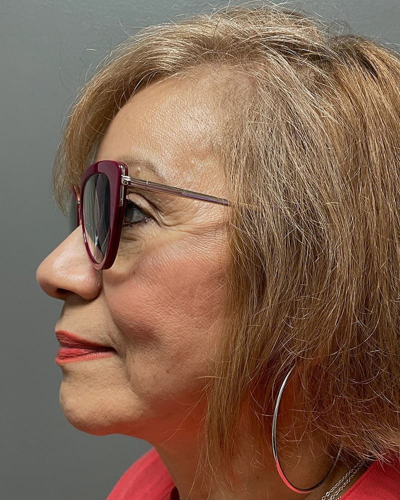 Upper Lip Lift Before & After Image