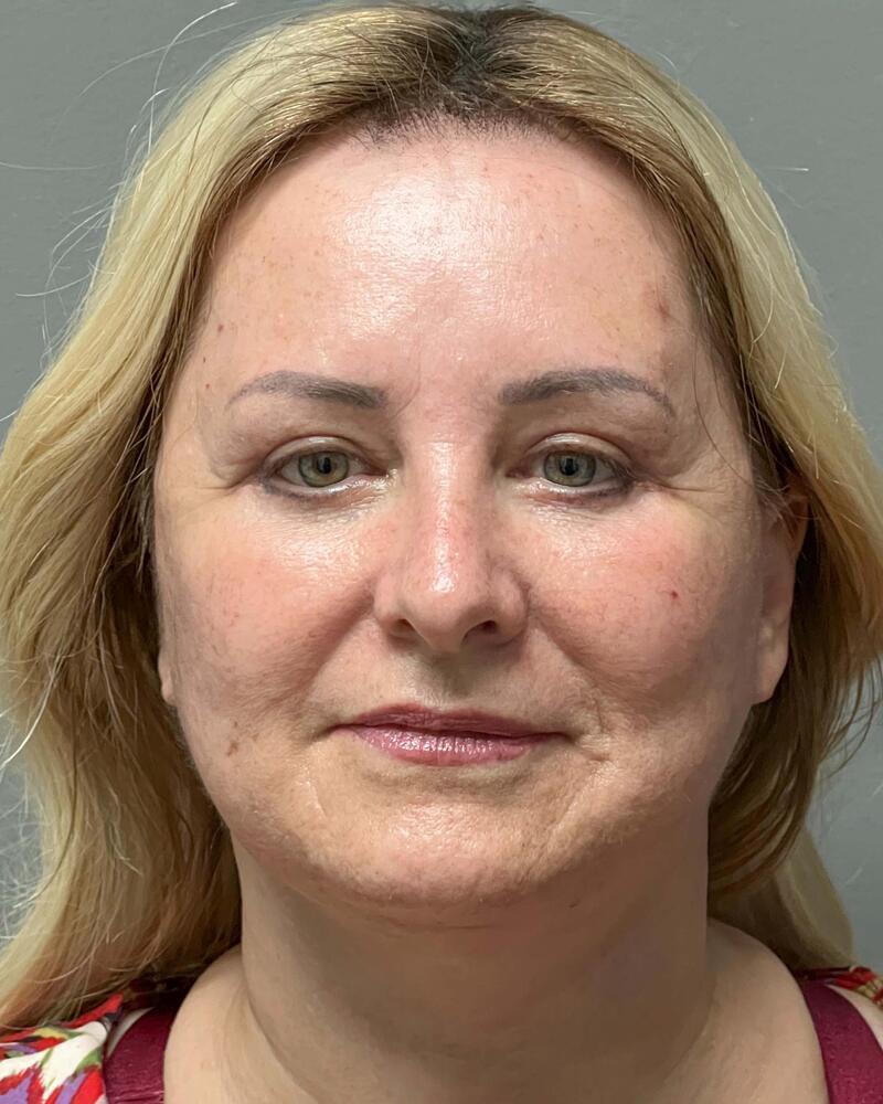Sculptra Before & After Image