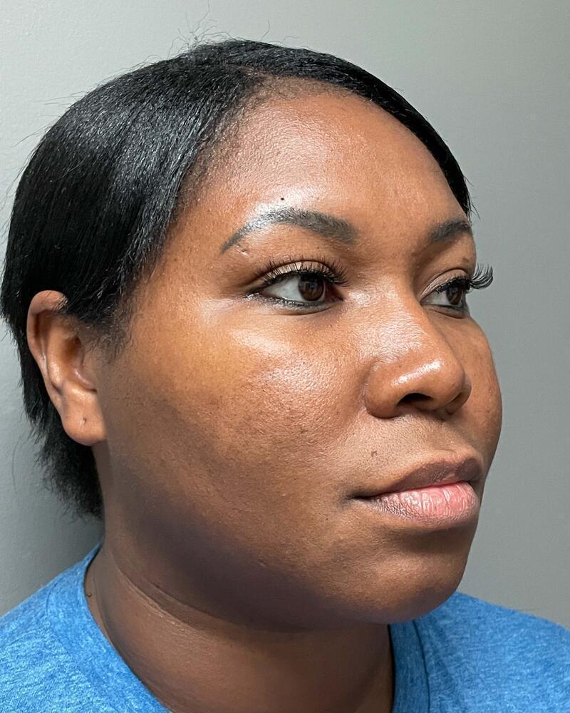 Upper Lip Lift Before & After Image