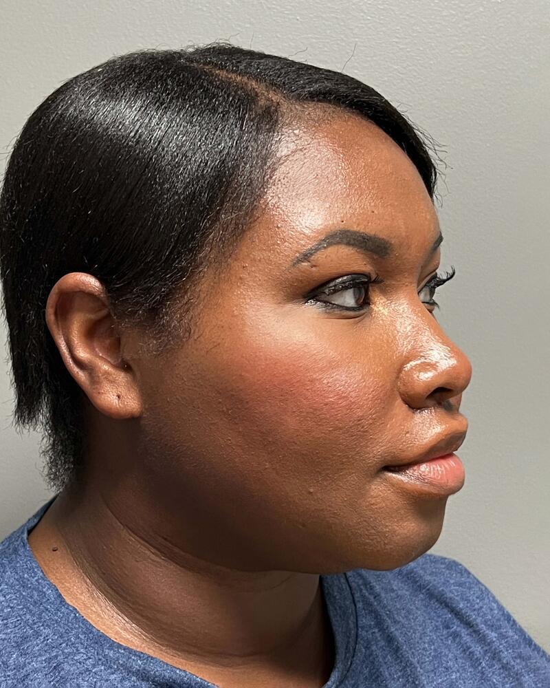 Upper Lip Lift Before & After Image