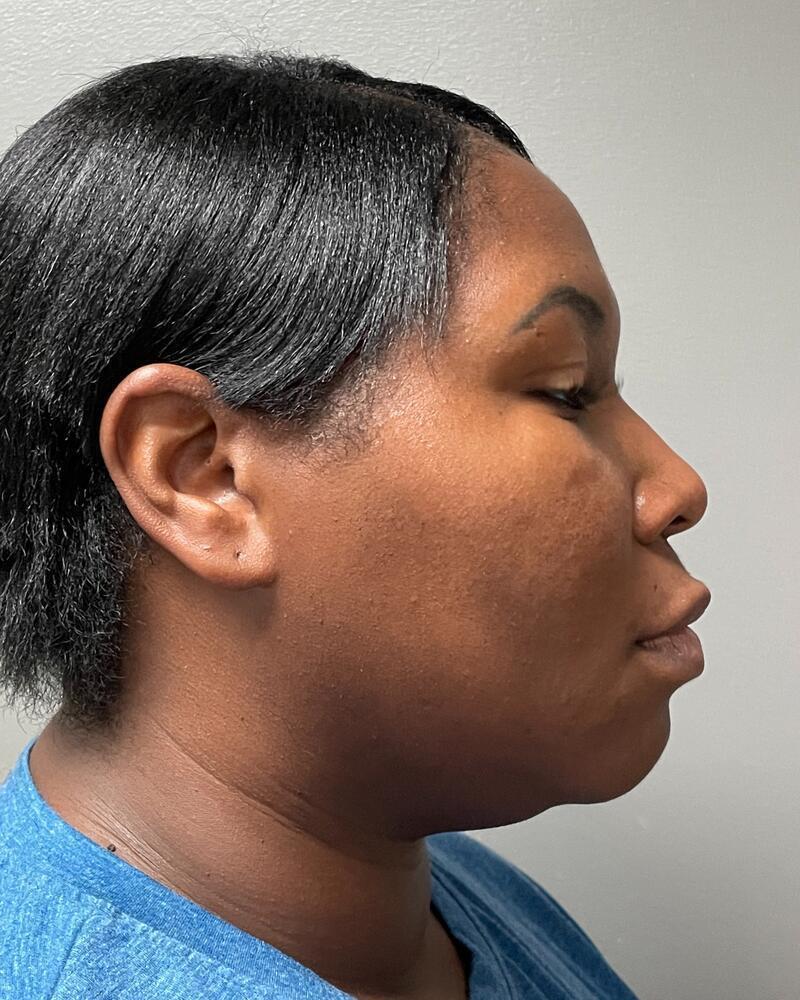 Upper Lip Lift Before & After Image