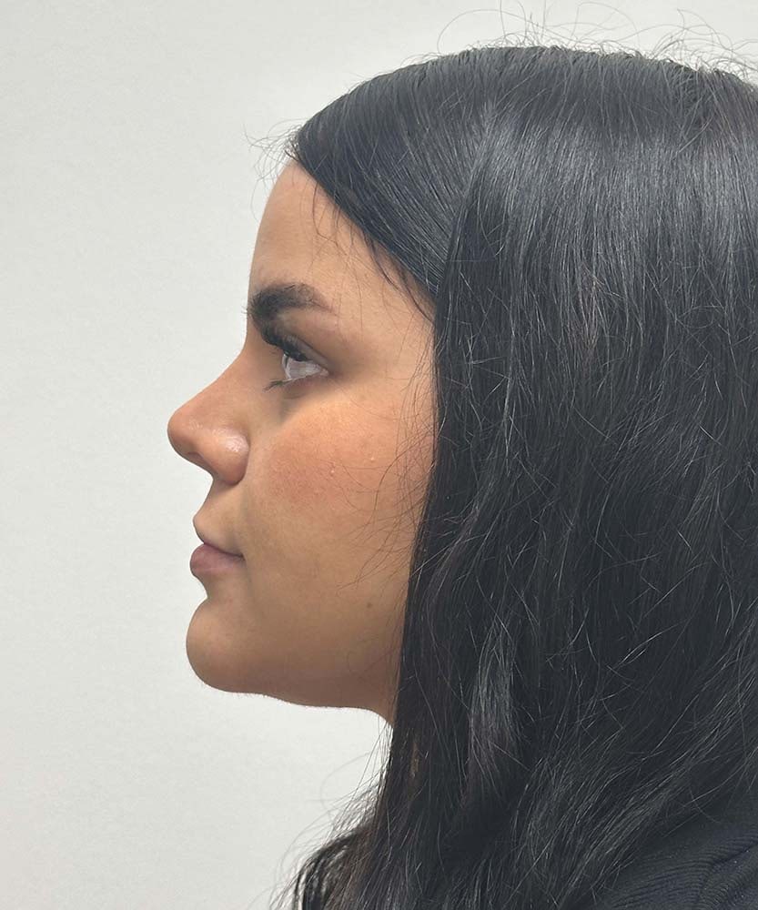 Upper Lip Lift Before & After Image