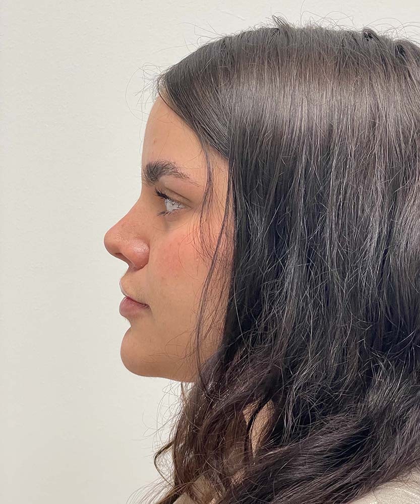 Upper Lip Lift Before & After Image
