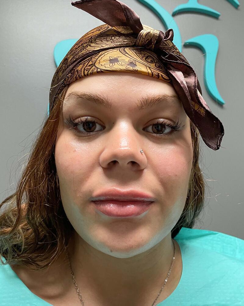 Upper Lip Lift Before & After Image