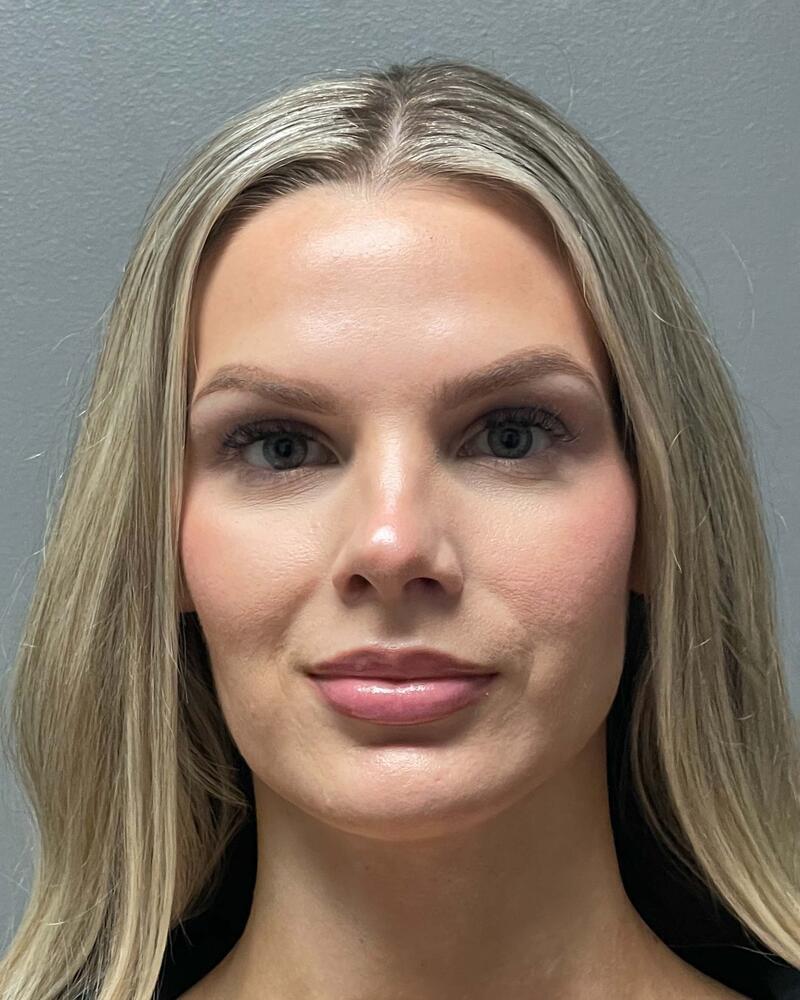 Upper Lip Lift Before & After Image