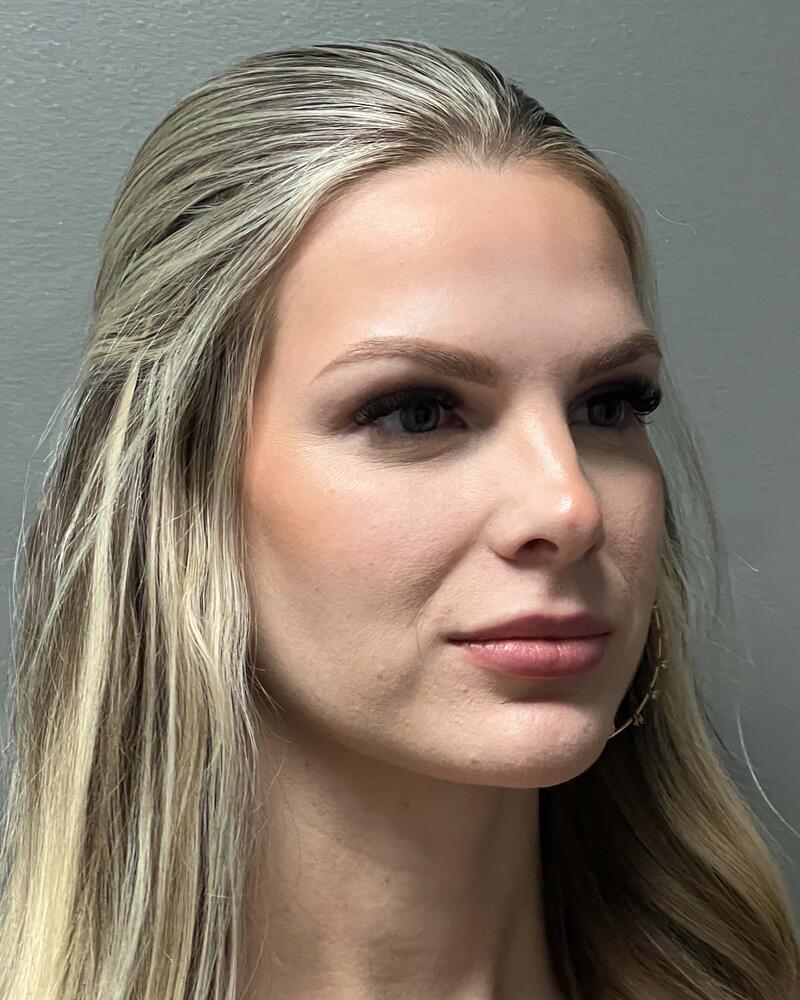 Upper Lip Lift Before & After Image
