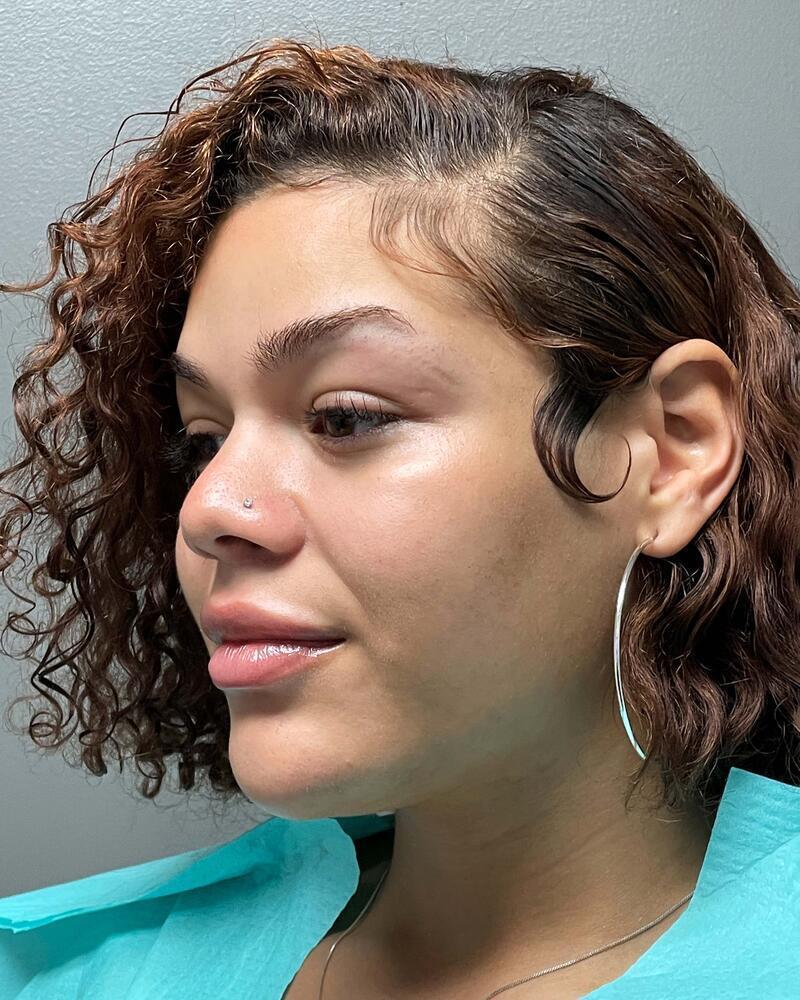 Upper Lip Lift Before & After Image