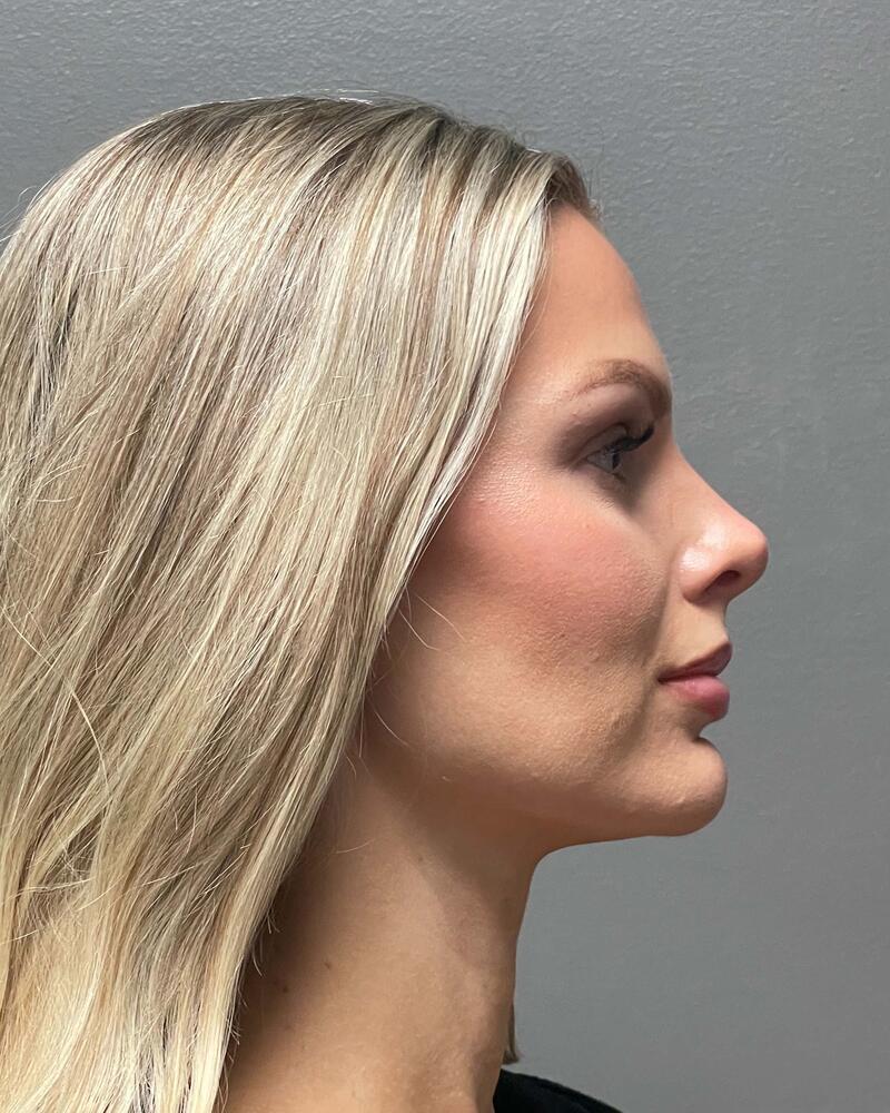Upper Lip Lift Before & After Image
