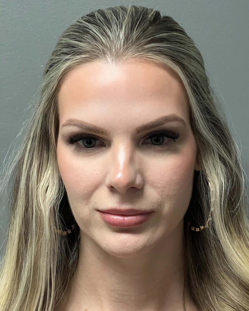 Upper Lip Lift Before & After Image