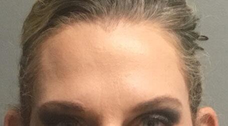 Sculptra Before & After Image