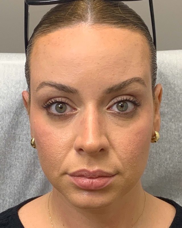 Botox Before & After Image