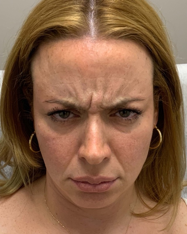 Botox Before & After Image