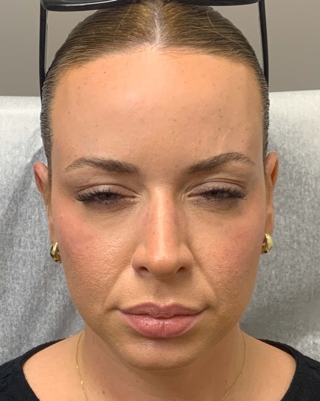 Botox Before & After Image