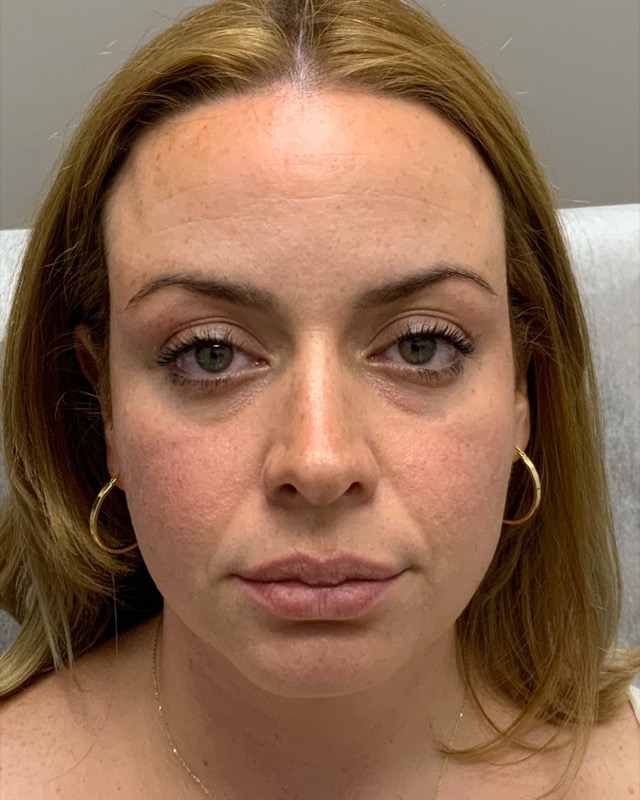 Botox Before & After Image