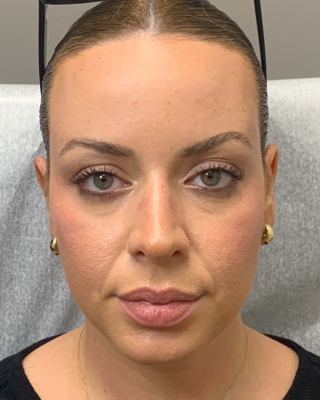 Botox Before & After Image