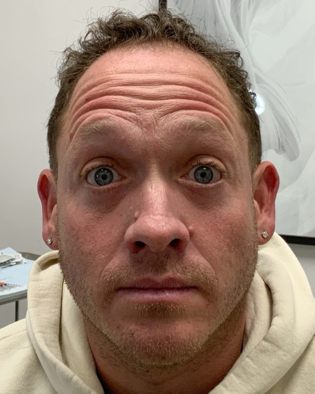 Botox Before & After Image