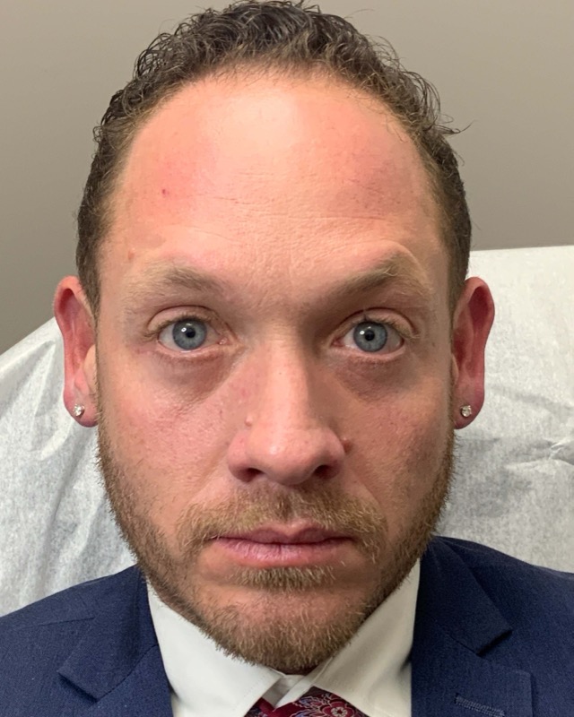 Botox Before & After Image