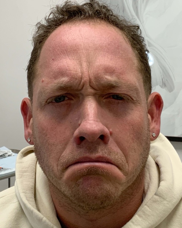 Botox Before & After Image