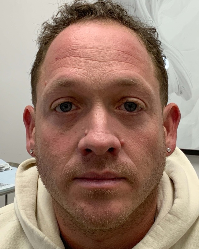 Botox Before & After Image