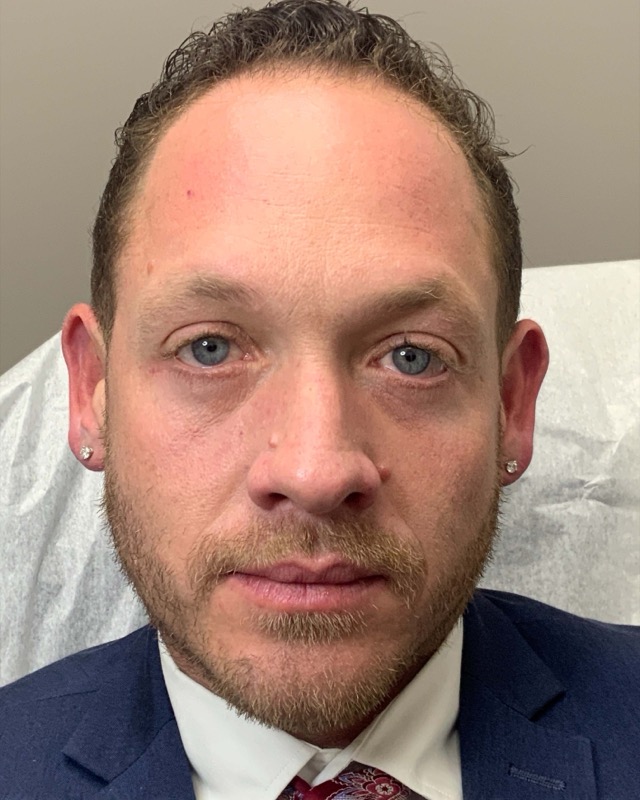 Botox Before & After Image