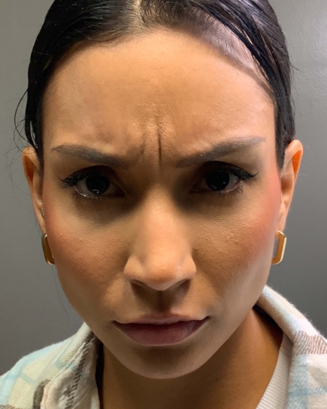 Botox Before & After Image