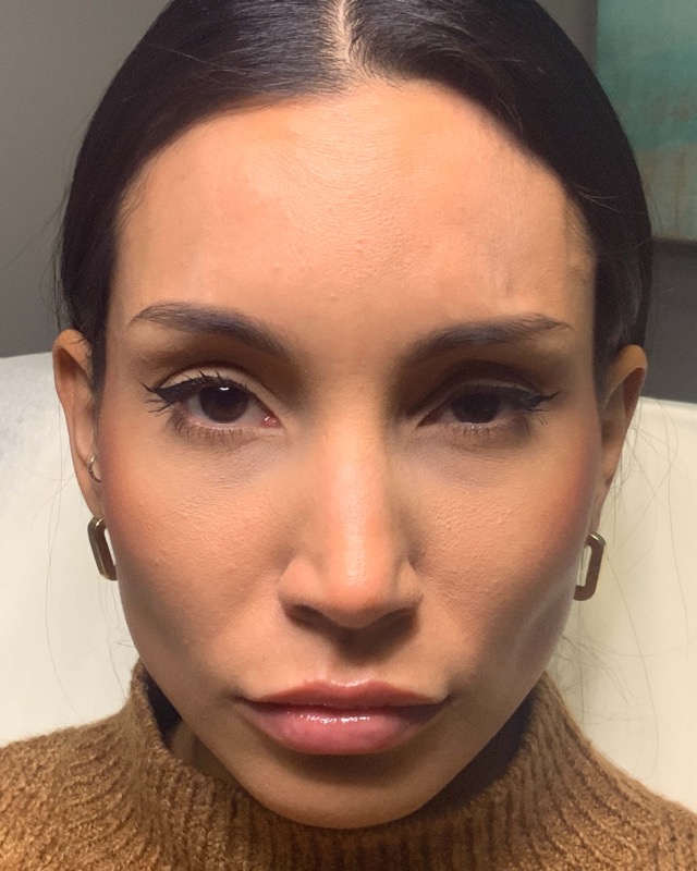 Botox Before & After Image