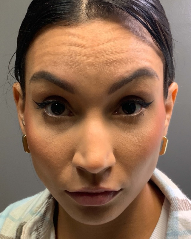 Botox Before & After Image