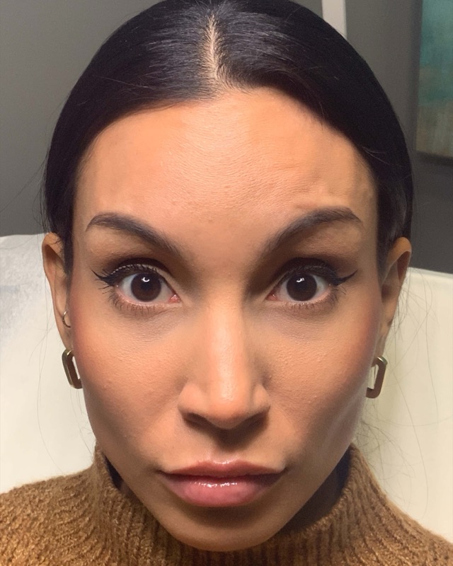 Botox Before & After Image