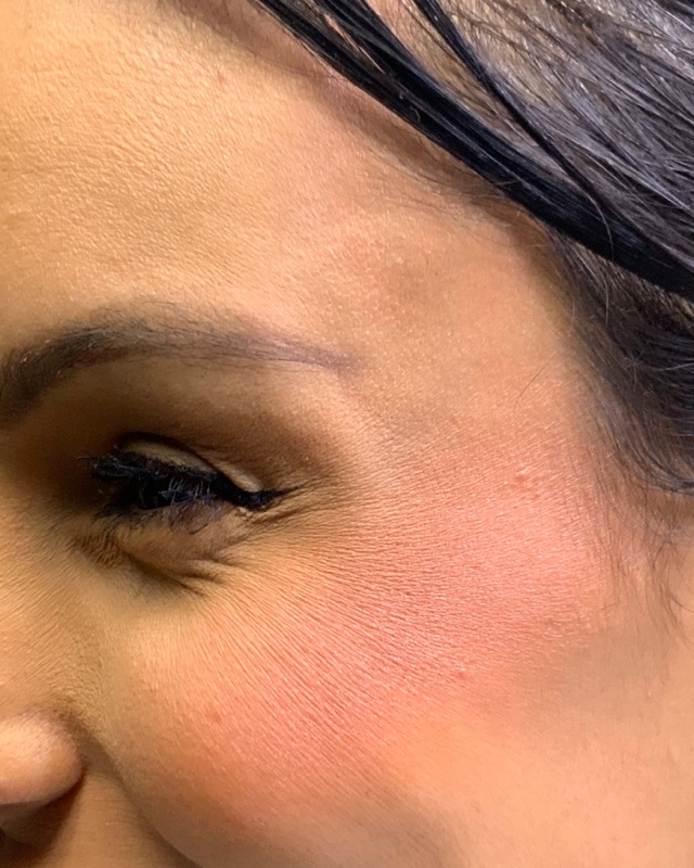 Botox Before & After Image